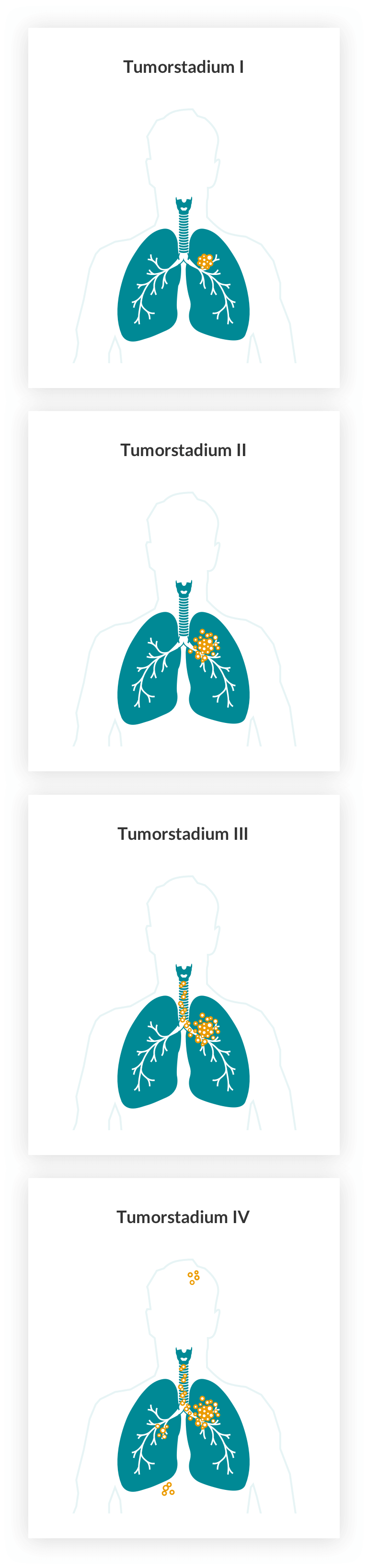 Lungenkrebs: Tumorstadien I-IV